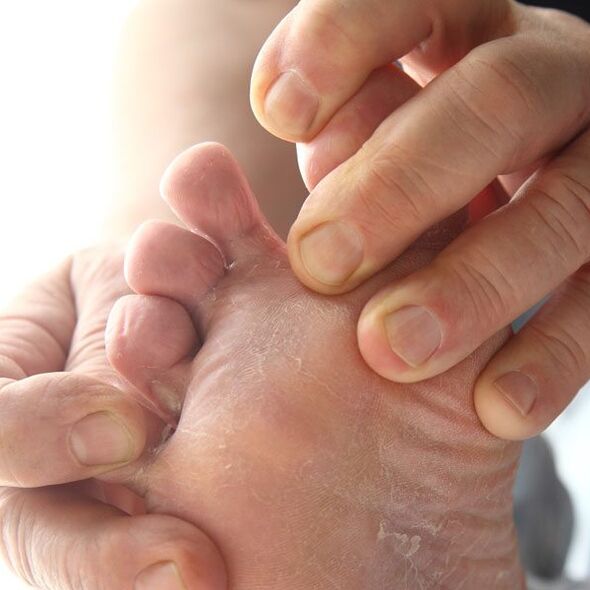 Glivice prizadenejo kožo med prsti