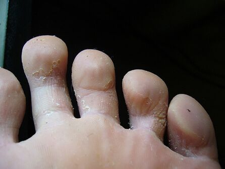 Luščenje in luščenje kože na nogah je znak glivic