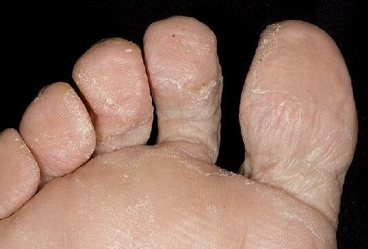 Manifestacije glivične okužbe na stopalih