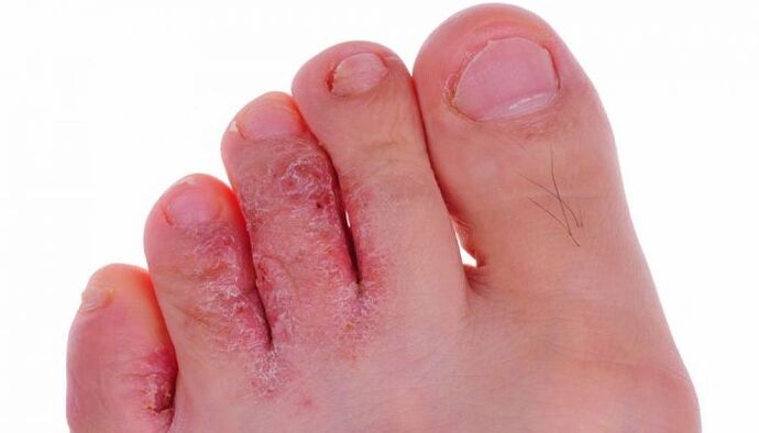 glivična okužba kože prstov na nogah