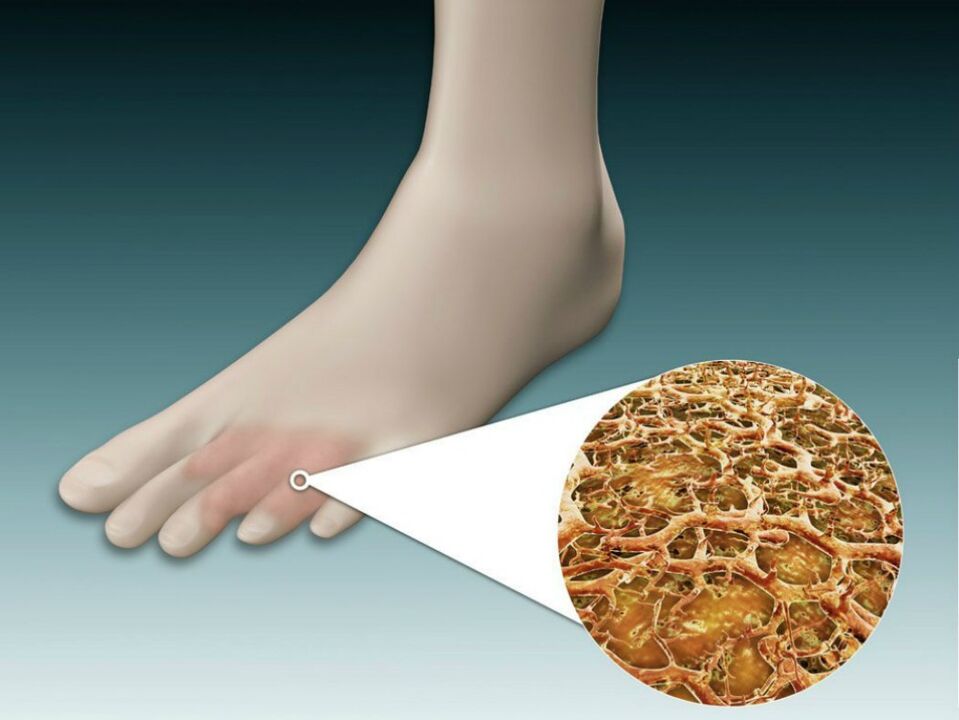 Rdečina kože med in blizu prstov na nogah z intertriginoznimi glivicami