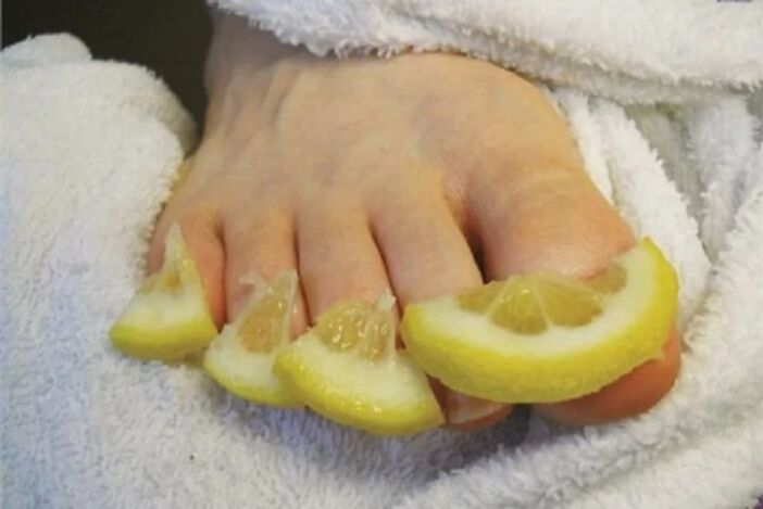 Obkladki iz limonovih kapljic - ljudsko zdravilo za glivice na nohtih